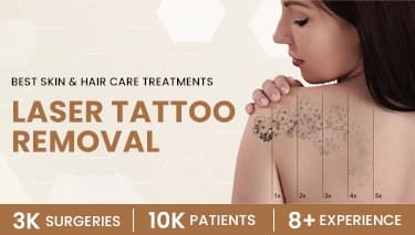 Best Laser Tattoo Removal in Delhi