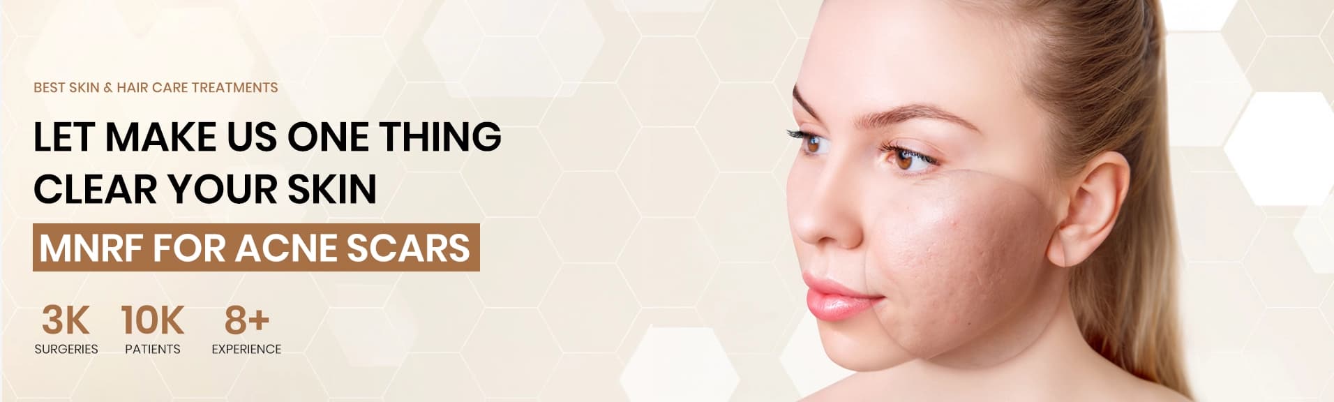 Best MNRF Acne Scar Treatment in Delhi
