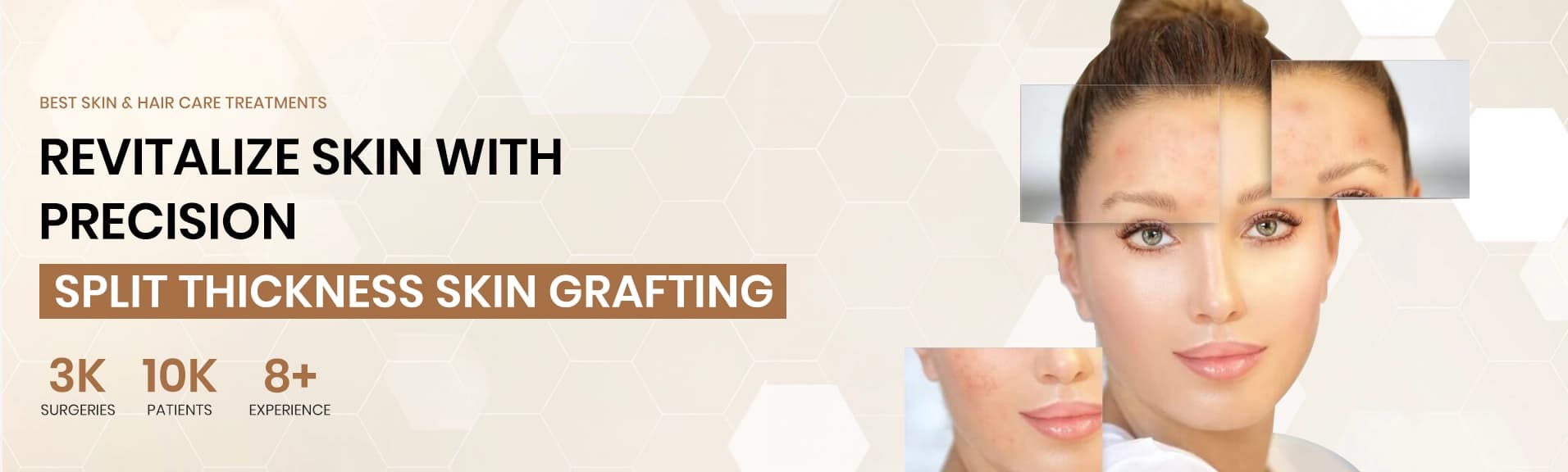 split thickness skin grafting desktop