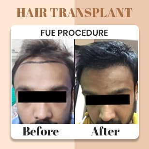 Hair Transplant 2