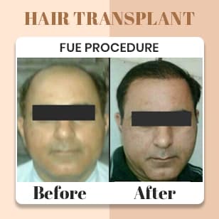 Hair Transplant 3