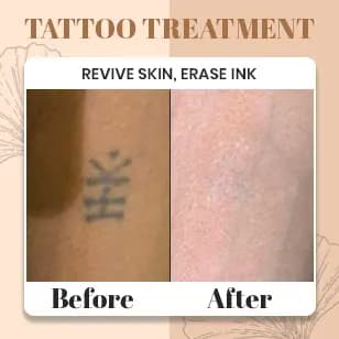 Tattoo Treatment 2