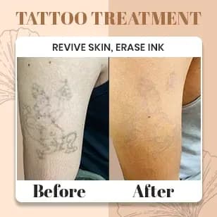 Tattoo Treatment 1