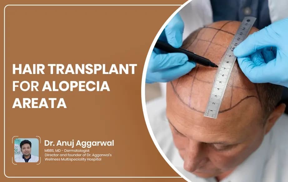 Hair Transplant for Alopecia Areata
