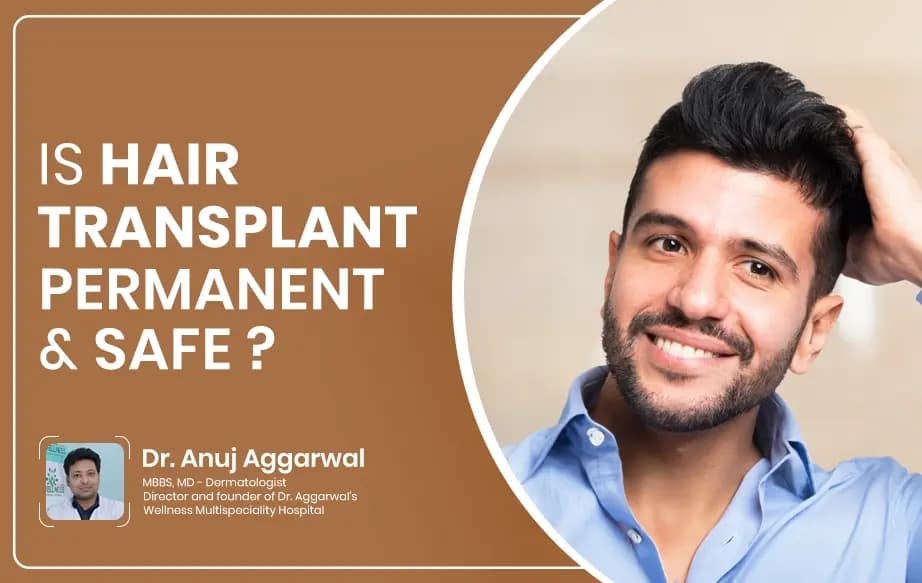 Is Hair Transplant Permanent and Safe?