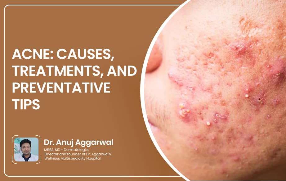 Acne Tips
