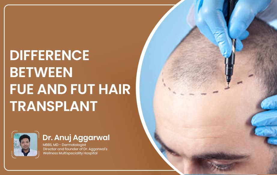 Difference Between FUE and FUT Hair Transplant