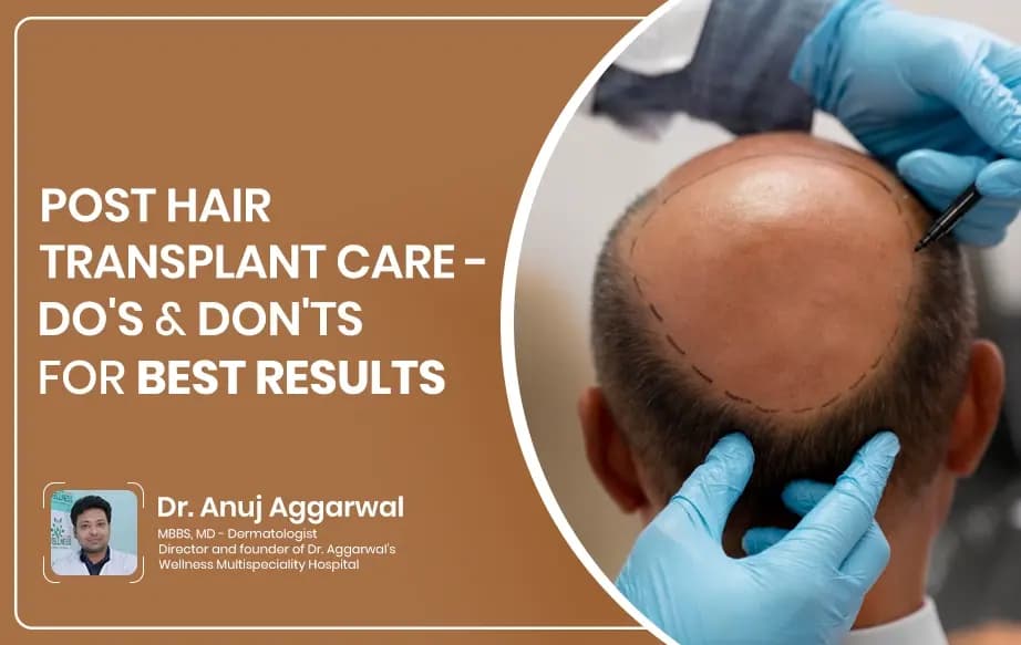 Post Hair Transplant Care