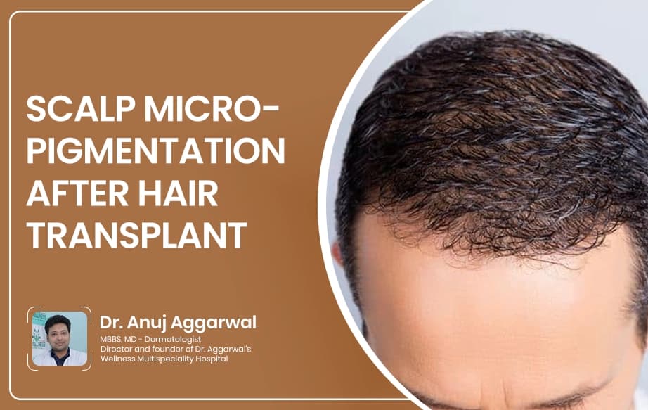 Scalp Micropigmentation After Hair Transplant
