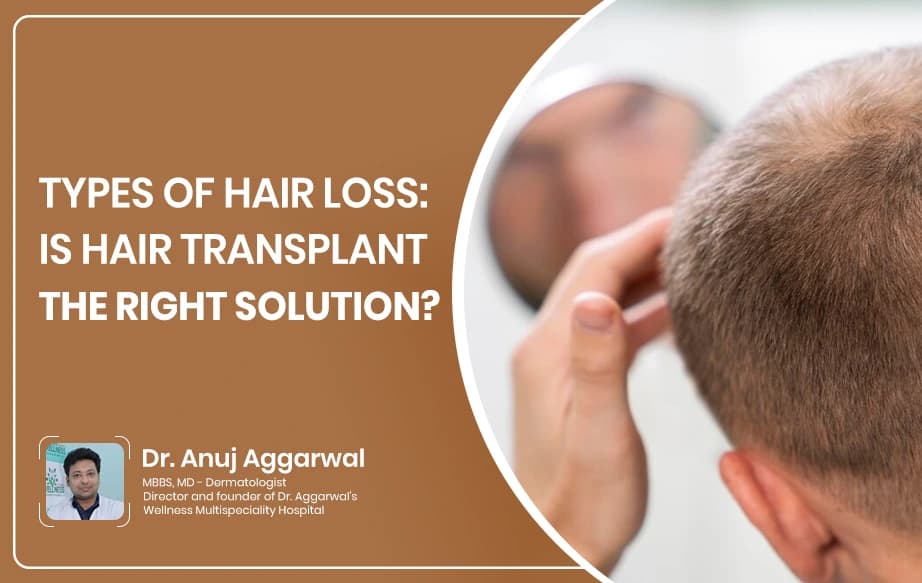 Types of Hair Loss