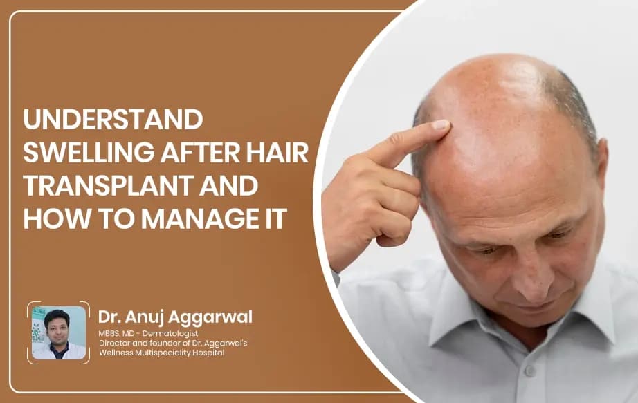 Understand Swelling After Hair Transplant and How to Manage It