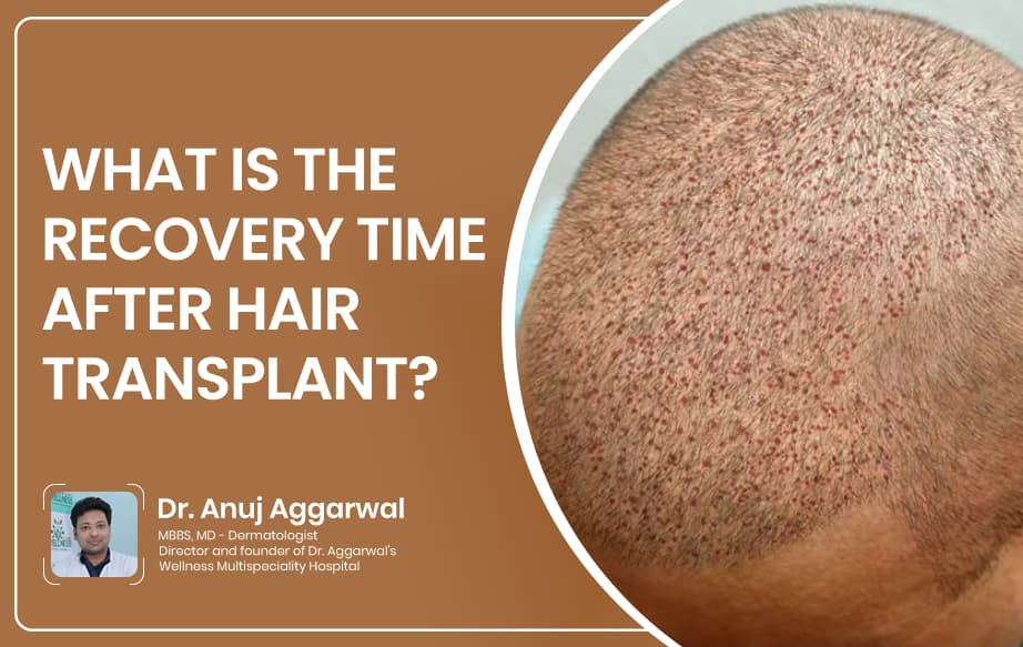 Hair transplant Recovery
