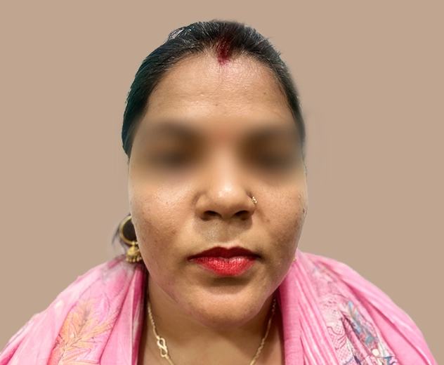 Carbon Facial