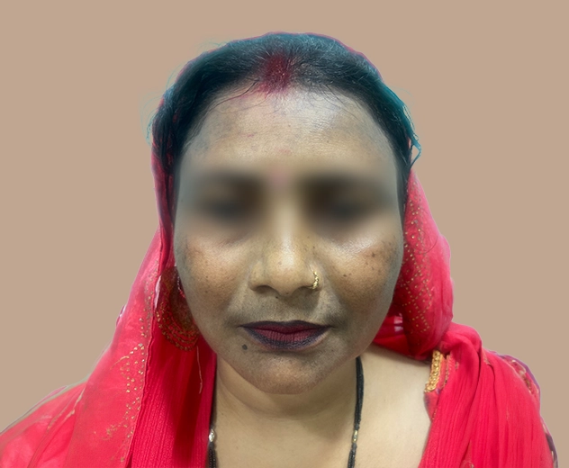 Face Treatment