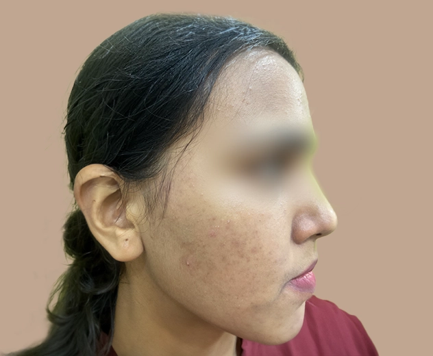 Peel Treatment